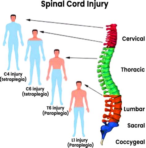 quadriparesis vs quadriplegia.